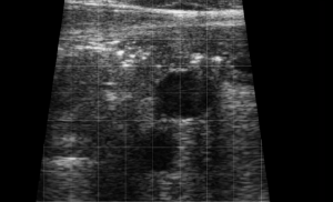 Calf Severe Lung Consolidation 5