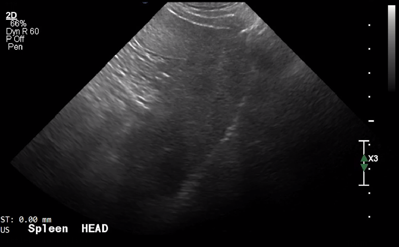 Spleen Head (Longitudinal) – NORMAL