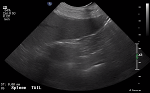 Spleen Tail (Longitudinal) - NORMAL