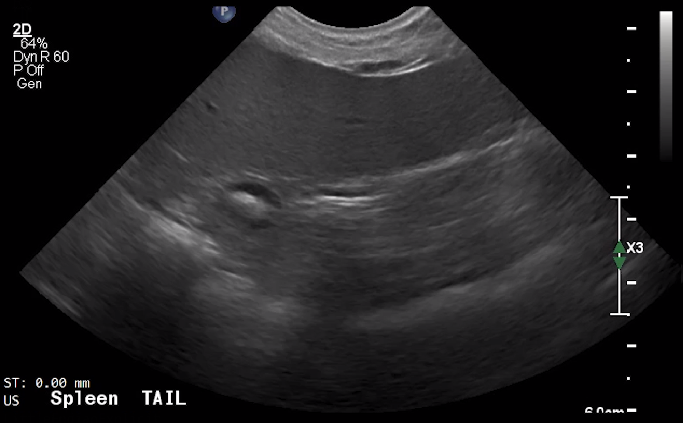 Spleen Tail (Transverse) – NORMAL