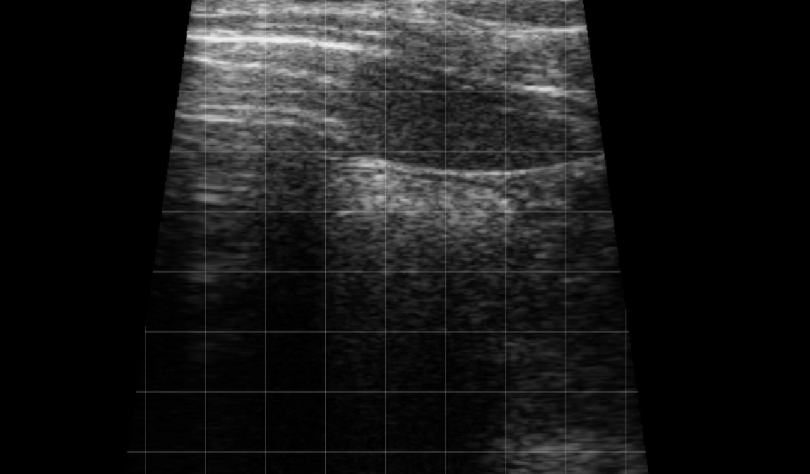 Left Thorax Landmark (Rib Space 6-10) – Spleen