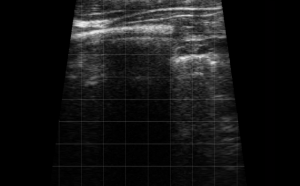 Right Thorax Landmark (Rib Space 1&2) - Thoracic Vessels