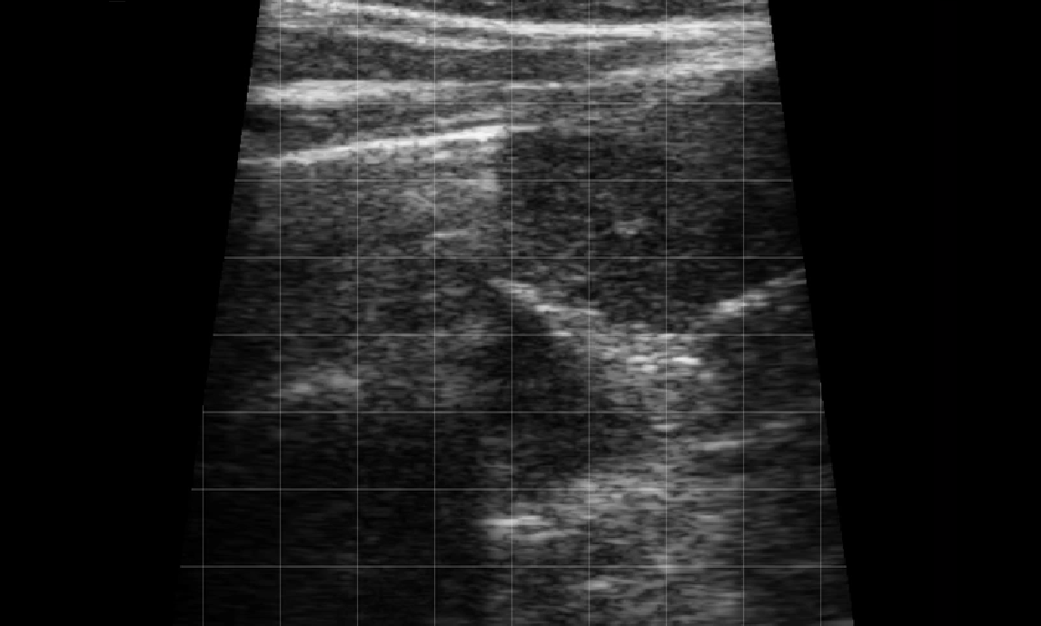 Left Thorax Landmark (Rib Space 1&2) – Thymus