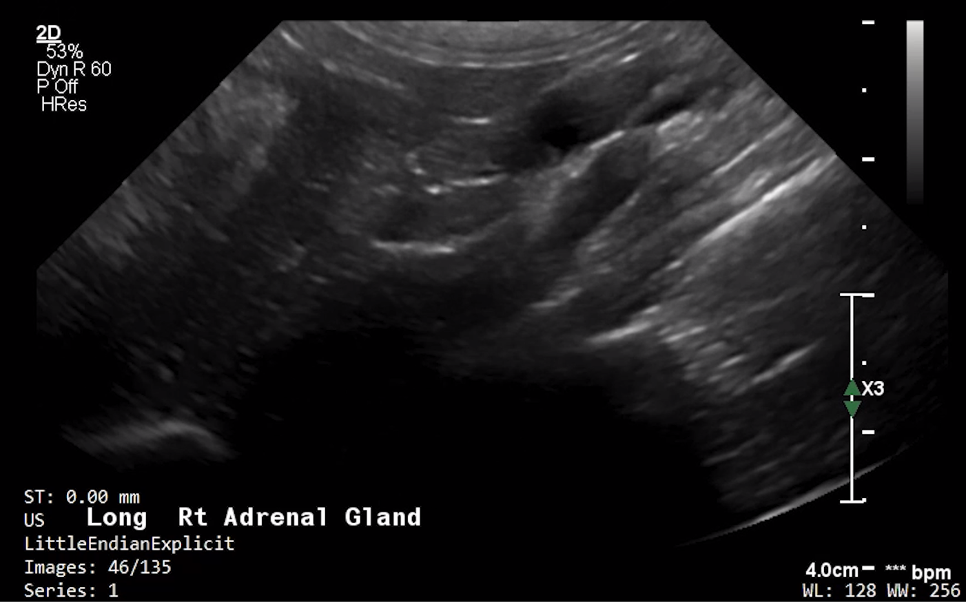 Feline Right Adrenal (Longitudinal) – NORMAL