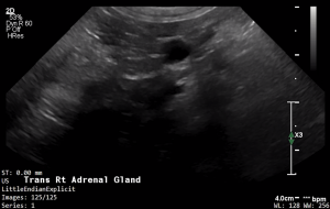 Feline Right Adrenal (Transverse) - NORMAL
