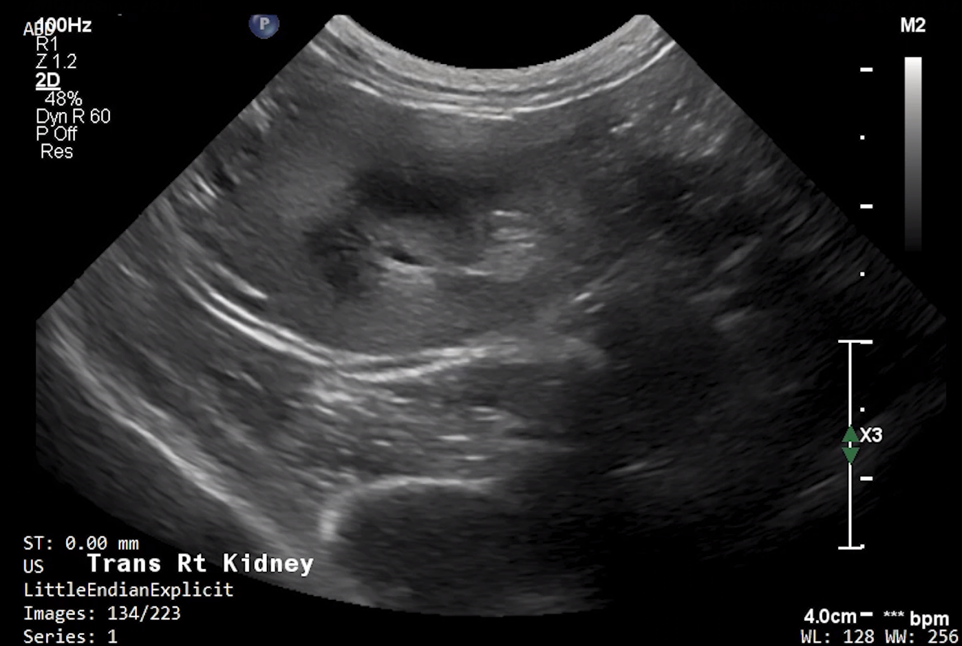 Feline Right Kidney (Transverse) – NORMAL